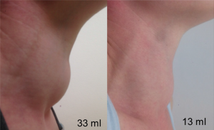 Thermoablation eines Schilddrüsenknotens. Volumen vor und nach einmaliger Behandlung nach 3 Monaten.